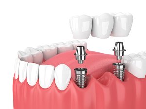 Digital image of an implant-retained bridge 