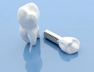 Single dental implant