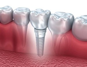 A single dental implant