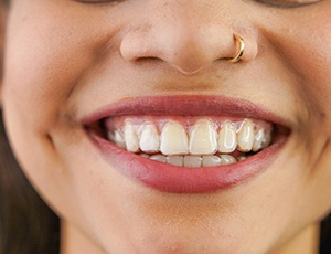 Closeup of woman smiling while wearing Invisalign aligners