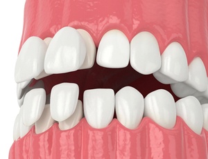 Veneers on teeth