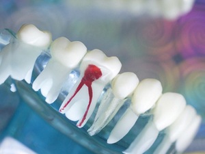 model of an infected tooth