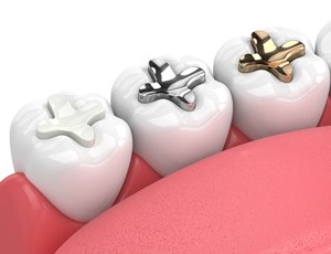 Different dental fillings