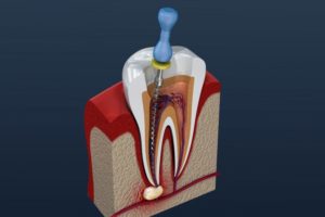 diagram of root canal