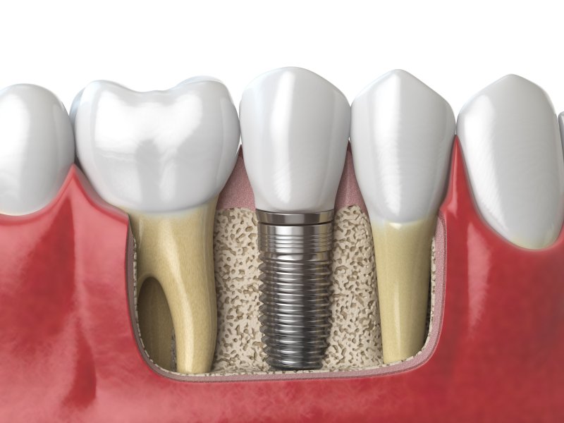 Illustration of dental implants