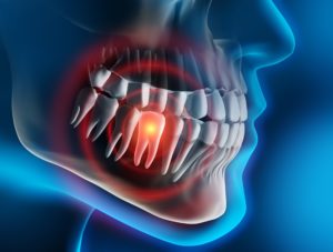 Digital model of a toothache