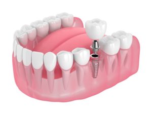 a digital representation of a dental implant