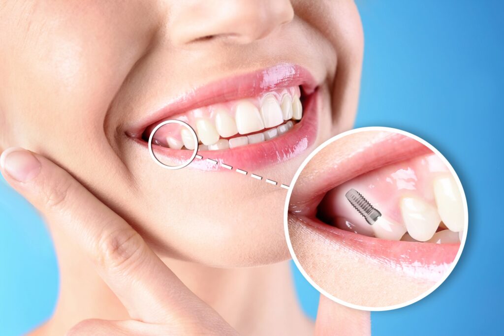 Nose-to-neck view of woman smiling with one tooth indicated as a dental implant