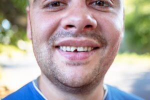 Man with chipped front tooth.
